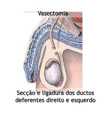 La vasectomía como método anticonceptivo tiene una efectividad de casi el 100% y es considerada. Vasectomia Esclareca Suas Duvidas O Urologista