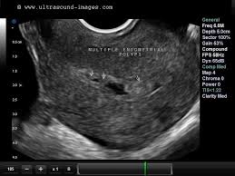 Polyps Endometrial Multiple Ultrasound Sonography Ultrasound Uterine Polyps