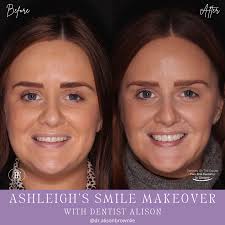 Ashleigh's Smile Story