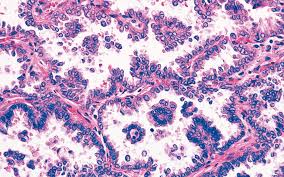 Papillary thyroid cancer (magnified at right) arising within ectopic thyroid tissue of a thyroglossal cyst is a rare occurrence (less than 1% of such cysts). Thyroid Cancer