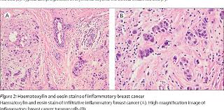 However, this kind of cancer can develop and anyone can develop inflammatory breast cancer, including men. Figure 2 From Inflammatory Breast Cancer Unique Biological And Therapeutic Considerations Semantic Scholar