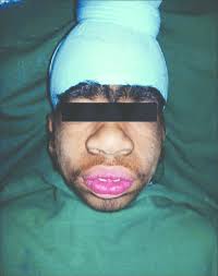 So i have facial hair quite high on my cheek. Downy Growth Of Hair Was Present On The Cheeks And Bushy Eyebrows Download Scientific Diagram
