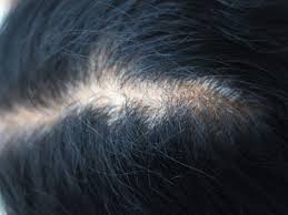 The scalp is the most commonly affected area, although patients commonly report the loss of hair. How To Reverse Hair Loss From Medication