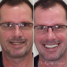 We did not find results for: All Teeth On 4 Dental Implants Sydney Full Mouth Fixed Dental Implants Dentist Ryde Gladesville North Ryde Parramatta Epping Hunters Hill