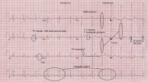 Image result for Q Wave