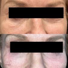 Aesthetic solutions (spa) is located in sedgwick county, kansas, united states. Before And After Aesthetic Solutions