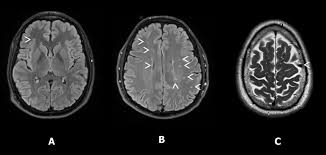 Image result for Incidental Imaging Finding