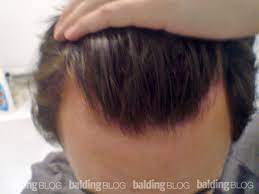 Thinning hair can be caused by a variety of factors, including stress or hormonal issues. 18 Year Old With Hair Loss Or Mature Hairline With Photos Wrassman M D Baldingblog