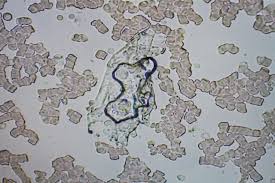 The reason for this decision is several patients infected with klebsiella pneumoniae ndm. Grozna Superbakteria Atakuje Spelnia Sie Czarna Wizja Mikrobiologow Gazeta Pomorska