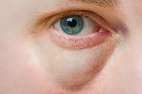 Home Remedies For Puffy Eyes How To Reduce Swelling Top 10 Home Remedies Puffy Eyes Remedy Cure Puffy Eyes Baggy Eyes