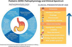 Image result for Pediatric Reflux