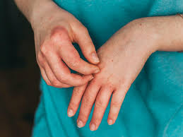 Skin peeling on the fingers can be a result of multiple things including eczema, psoriasis, or an immune disorder or infection. Fingertips Peeling 12 Causes And Treatments