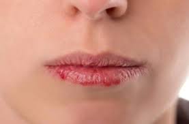 Image result for Lip Cancer