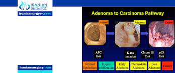 Rectal cancer as the name suggests is cancer forming in the rectum. Rectal Cancer Symptoms Iranian Surgery