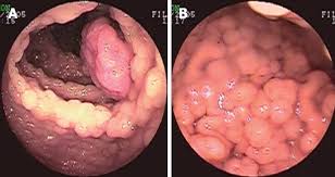 Image result for Gardner Sendromu