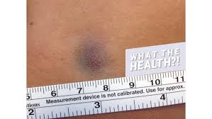 Added together, (including merkel cell carcinoma) these types of rarer skin cancers make up about 1 out of every 100 … Woman S Tiny Bruise Turned Out To Be A Rare Form Of Skin Cancer Health Com