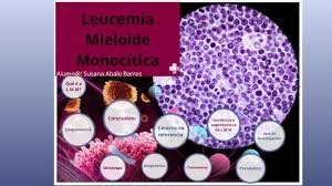 Los niños con leucemia, generalmente, sufren del tipo agudo. Leucemia Mieloide Monocitica By Susana Abalo Barros
