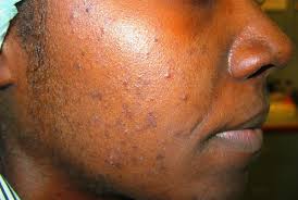 Acne Vulgar Trastornos Dermatologicos Manual Merck Version Para Profesionales