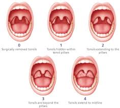 Tonsil Size Scoring Sleep Apnea Sleep Apnea Remedies