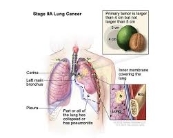 This growth can spread beyond the lung by the process of metastasis into nearby tissue or other parts of the body. Lung Cancer Medlineplus Genetics