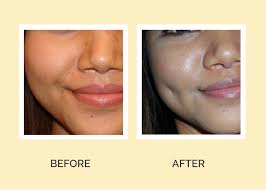 A dimple (also known as a gelasin) is a small natural indentation in the flesh on a part of the human body, most notably in the cheek. Dimple Creation Archives Skinarts Aesthetics