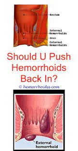 Do I Have Hemorrhoids Cure For Hemorrhoids Bleeding Hemorrhoids Hemorrhoids
