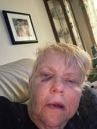 Experiences with Postural Orthostatic Tachycardia Syndrome diagnosis and  management