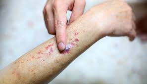 Forearm showing petechiae and purpura with a clinician pointing to a bruised area, illustrating bleeding-related skin signs