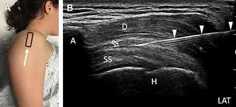 Image result for Subacromial Space Injection