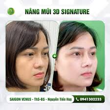 GIẢI MÃ SÓNG MŨI 3D: CÔNG NGHỆ TẠO DÁNG MŨI THÔNG MINH THEO TỪNG MILIMET