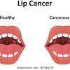Common risk factors for lip cancer include prolonged sun exposure, heavy alcohol intake, and tobacco use. Https Encrypted Tbn0 Gstatic Com Images Q Tbn And9gcs Kqt Z76zwp1hjvd Kfmytdsvgnjvsnxbb4m8hzfp621lcvyz Usqp Cau