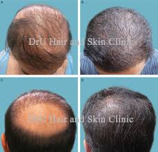 The maxsoft shampoo brush is ideal for sensitive scalps that need gentle, soft exfoliation to stimulate new hair growth. New Research Shows Hair Growth Possible In Those With Severe Baldness And Botched Hair Surgery Results Using Novel Ugraft Body Hair Transplant Bht