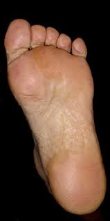 Dry Cracked Skin On Feet Upclever