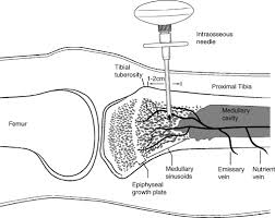 Image result for Intraosseous Access