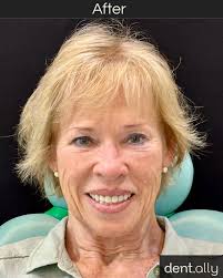 Meet Mary Tabone, who travelled to Dent Ally India for a complete Smile  Makeover and left with a brighter, more confident, and naturally beautiful  smile! Her smile transformation was crafted with: ✓