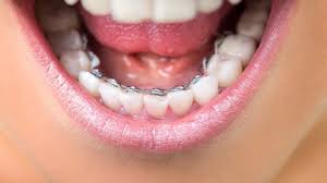 How long to floss teeth with braces. What Are Braces Behind Teeth Rome Orthodontics