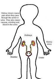 But, as the body is the natural source of oxalates, diet correction will unlikely completely prevent kidney stone formation from oxalates. Dietary Tips To Prevent Kidney Stones