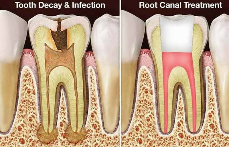 Root Canal Treatment product image