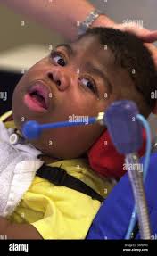 Dwarfism children hi-res stock photography and images