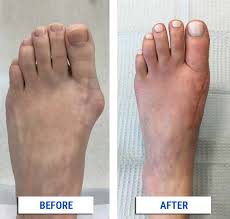 Bunions are when a bump forms at the base of the big toe. Bunion Correction Alpine Foot Specialists