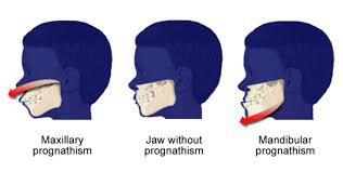 How we choose to fix the underbite varies. Underbite Correction Kanata Ottawa On Orthodontist Stittsville