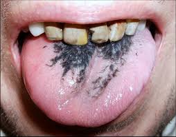Image result for black hairy tongue symptoms