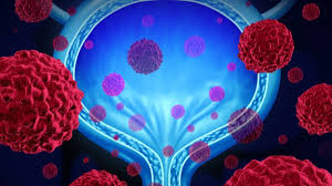 Find more information about bladder cancer, the stages of bladder cancer, and available treatment options. Merck S Keytruda Fails To Hit Mark In First Line Bladder Cancer Treatment Trial Biospace