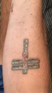 Again, this varies from person to person. Removal Of Tattoo With Keloid Scarring Tattooremoval