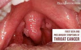 There is no test to find out a person's hpv status. Throat Cancer Caused By Hpv Hhh Cervical Cancer Oral Sex