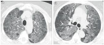 Scielo Brasil Adalimumab Induced Acute Interstitial Lung Disease In A Patient With Rheumatoid Arthritis Adalimumab Induced Acute Interstitial Lung Disease In A Patient With Rheumatoid Arthritis