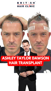 DHT and hair loss: Pro Bodybuilders...