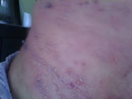 You can write the word in kanji, hiragana. Ubat Kayap Herpes Zoster Shingle Medicine Photos Facebook