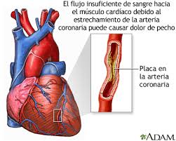 Espasmo De Las Arterias Coronarias Medlineplus Enciclopedia Medica