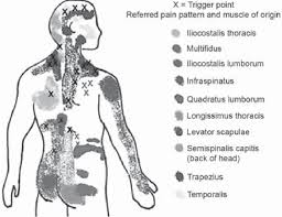 Image result for Tender Point